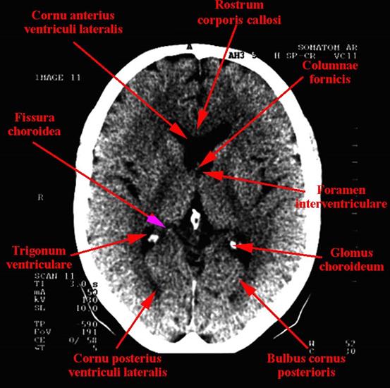 tomografia komputerowa głowy - 10b.jpg